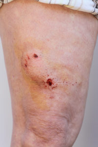 Dog bite, puncture wound on human leg, the victim of which would benefit from a dog bite attorney